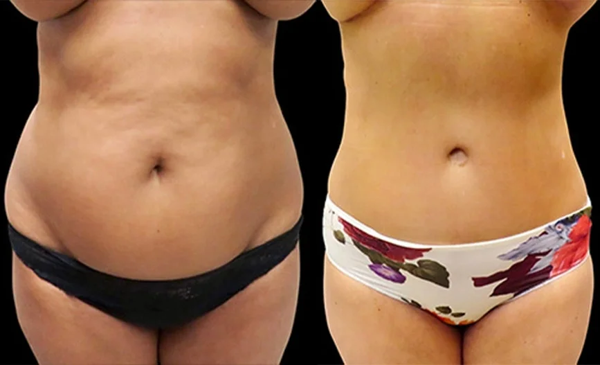 Real patient results in Owings Mills, MD Performed by Steven J. Rottman MD