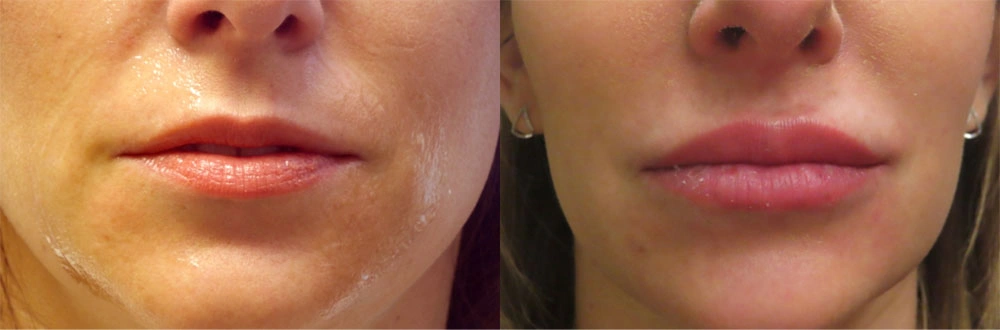 Real patient results in Owings Mills, MD Performed by Steven J. Rottman MD