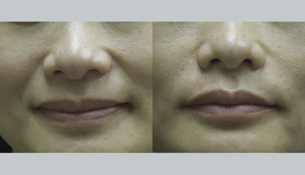 Real patient results in Owings Mills, MD Performed by Steven J. Rottman MD