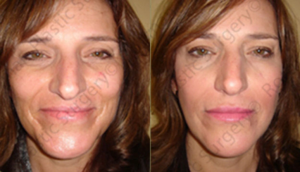 Real patient results in Owings Mills, MD Performed by Steven J. Rottman MD