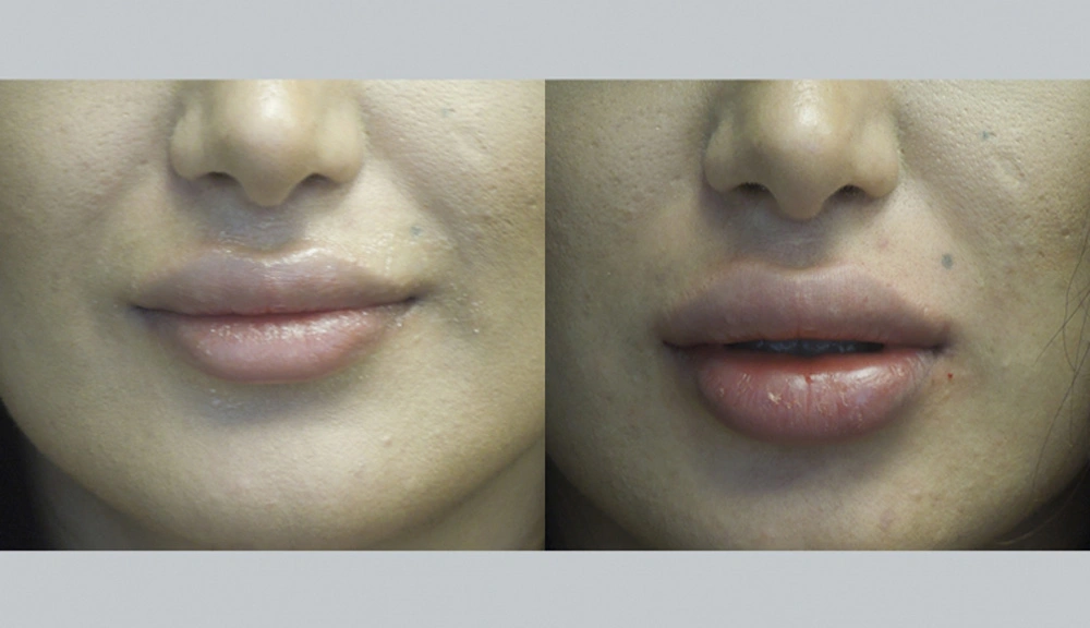Real patient results in Owings Mills, MD Performed by Steven J. Rottman MD