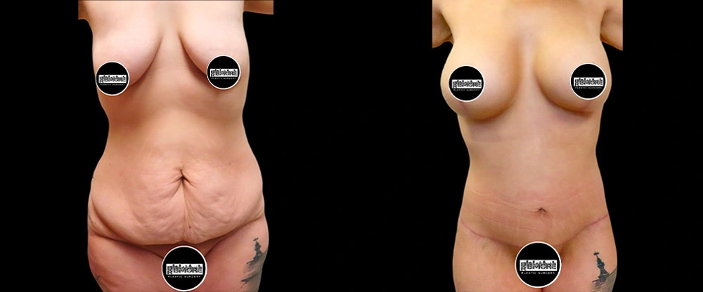 Real patient results in Owings Mills, MD Performed by Steven J. Rottman MD