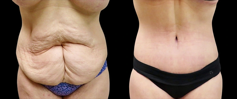 Real patient results in Owings Mills, MD Performed by Steven J. Rottman MD