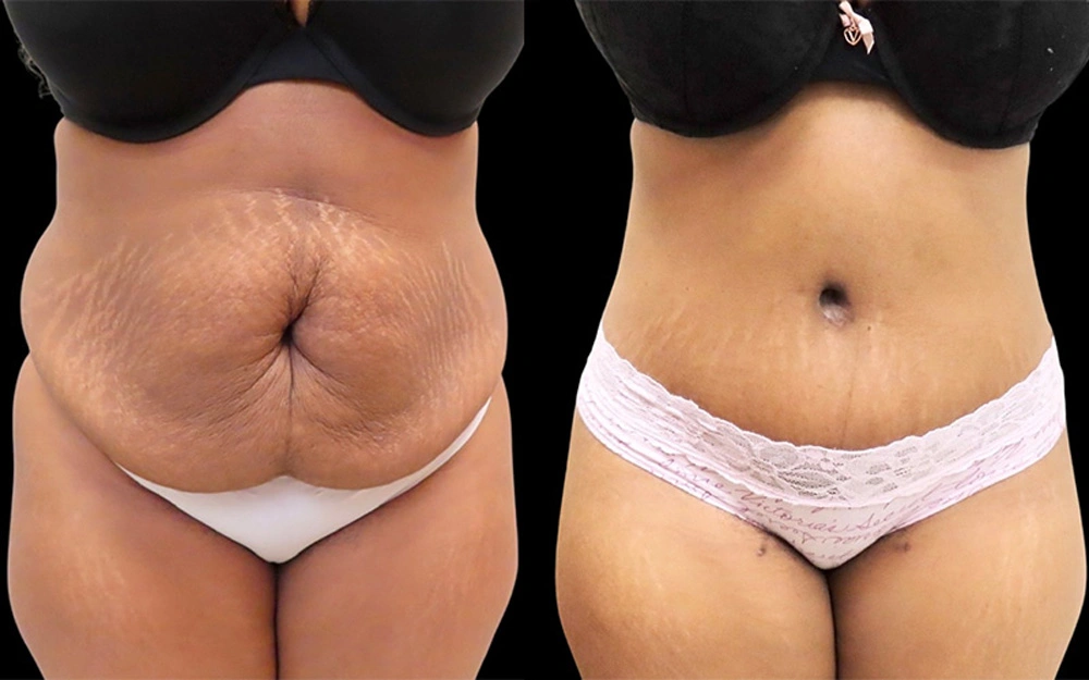 Real patient results in Owings Mills, MD Performed by Steven J. Rottman MD
