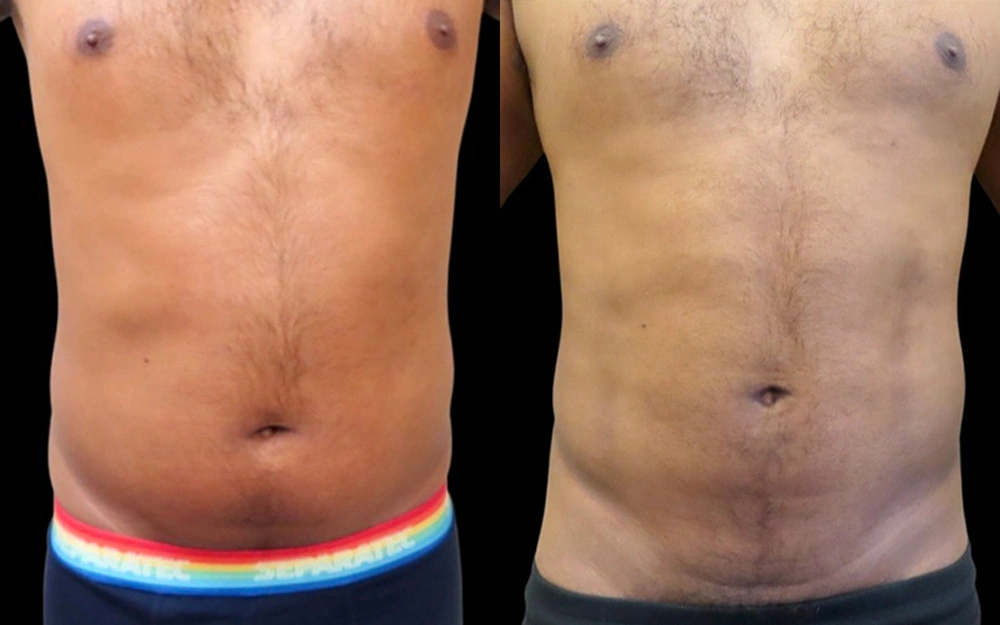 Real patient results in Owings Mills, MD Performed by Steven J. Rottman MD