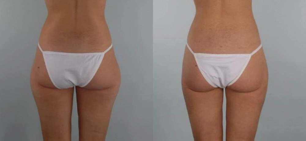 Real patient results in Owings Mills, MD Performed by Steven J. Rottman MD