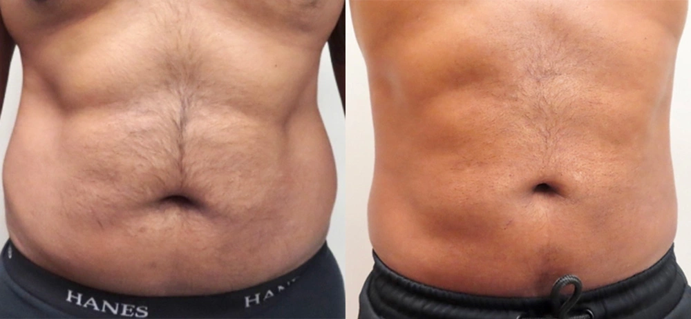 Real patient results in Owings Mills, MD Performed by Steven J. Rottman MD