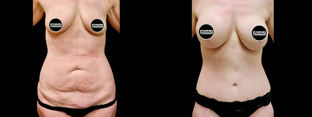 Real patient results in Owings Mills, MD Performed by Steven J. Rottman MD