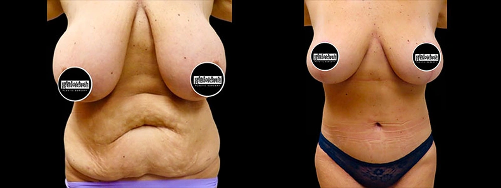 Real patient results in Owings Mills, MD Performed by Steven J. Rottman MD