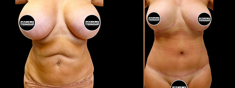 Real patient results in Owings Mills, MD Performed by Steven J. Rottman MD