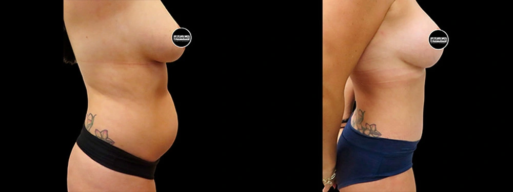 Real patient results in Owings Mills, MD Performed by Steven J. Rottman MD