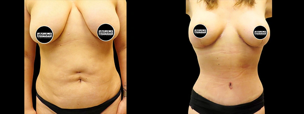 Real patient results in Owings Mills, MD Performed by Steven J. Rottman MD
