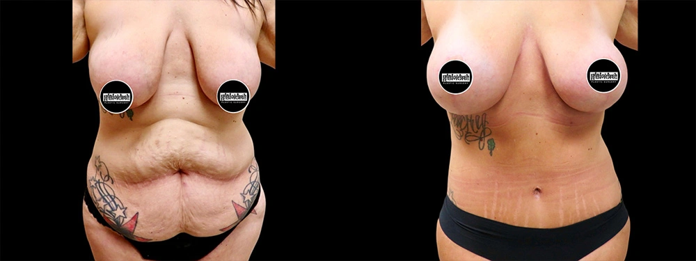 Real patient results in Owings Mills, MD Performed by Steven J. Rottman MD