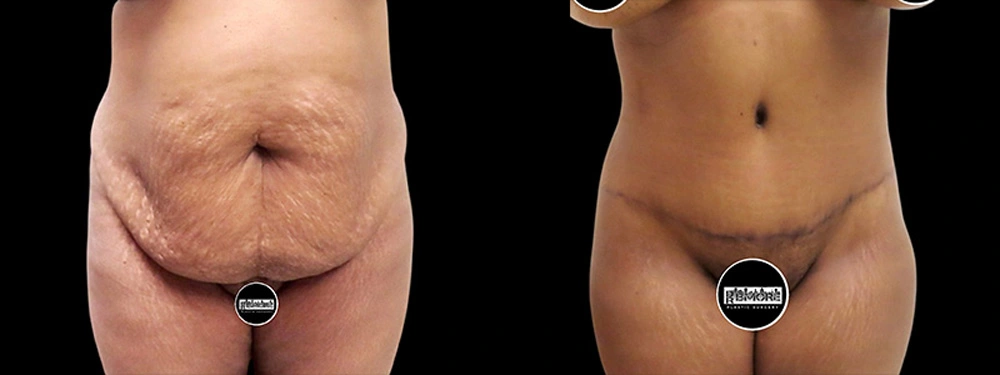Real patient results in Owings Mills, MD Performed by Steven J. Rottman MD
