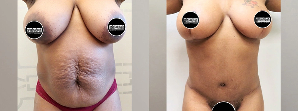 Real patient results in Owings Mills, MD Performed by Steven J. Rottman MD