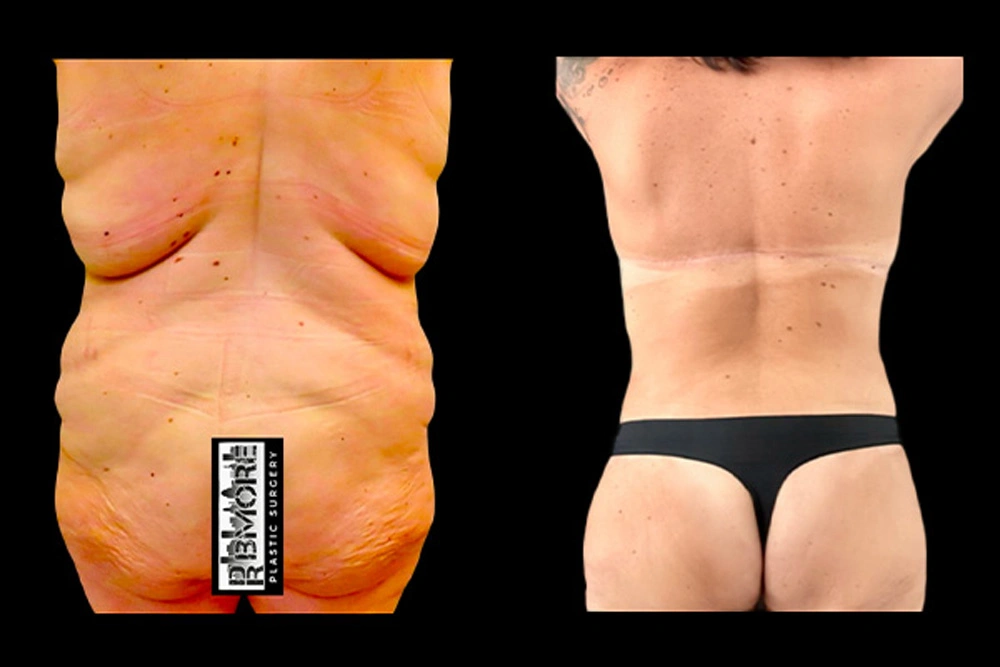 Real patient results in Owings Mills, MD Performed by Steven J. Rottman MD