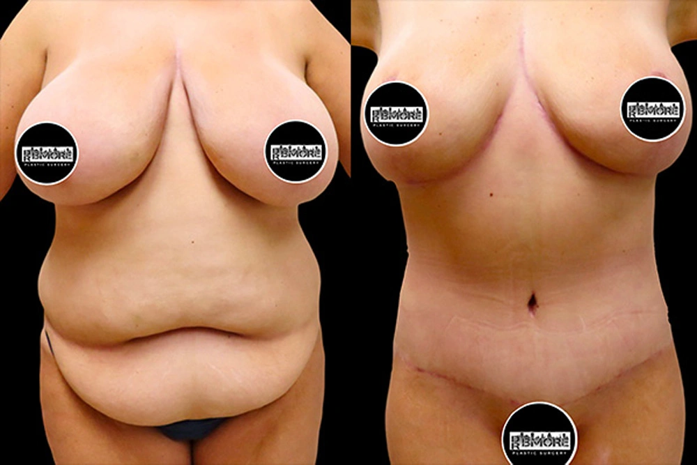 Real patient results in Owings Mills, MD Performed by Steven J. Rottman MD