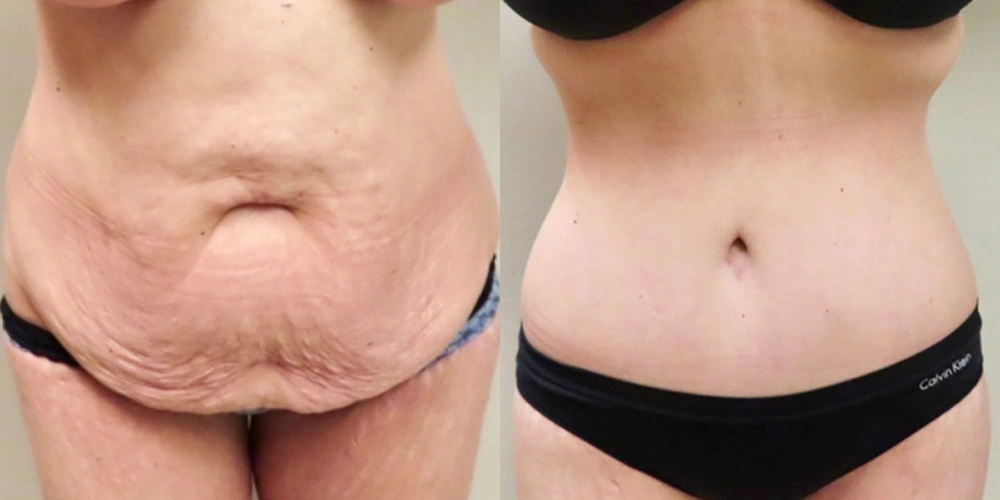 Real patient results in Owings Mills, MD Performed by Steven J. Rottman MD