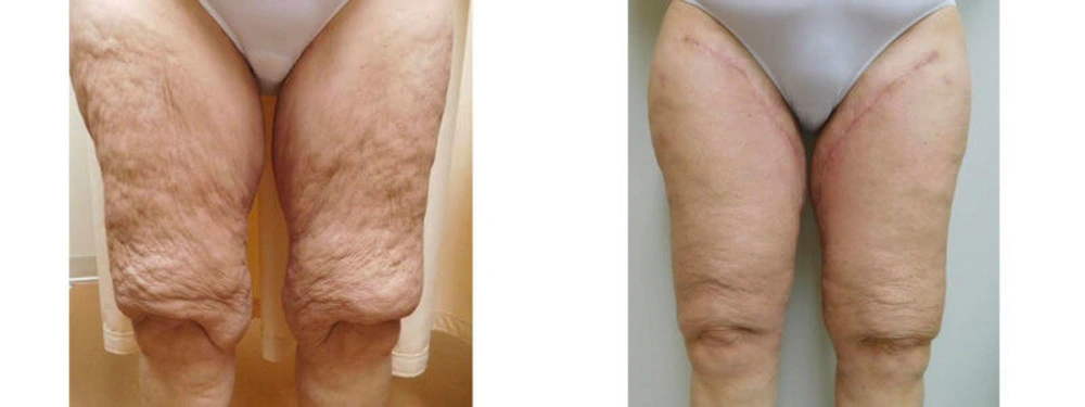 Real patient results in Owings Mills, MD Performed by Steven J. Rottman MD