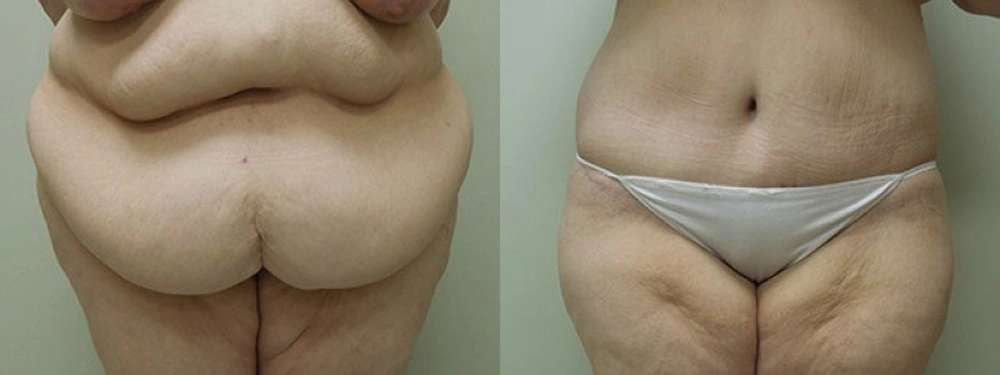 Real patient results in Owings Mills, MD Performed by Steven J. Rottman MD