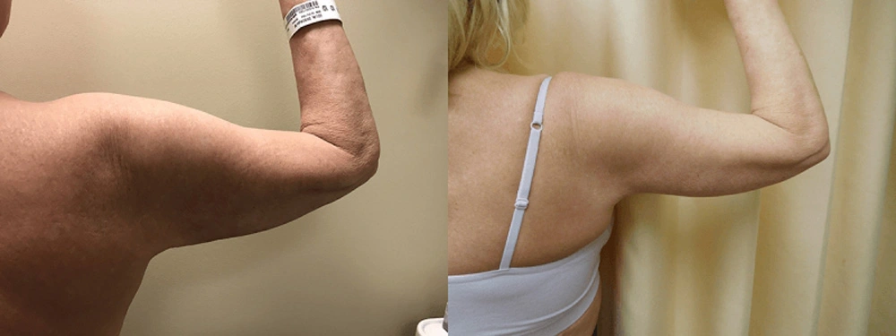 Real patient results in Owings Mills, MD Performed by Steven J. Rottman MD
