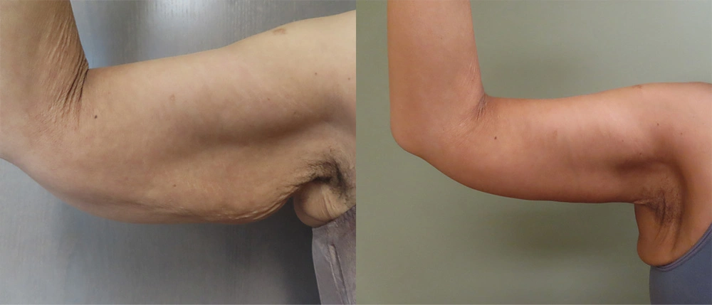 Real patient results in Owings Mills, MD Performed by Steven J. Rottman MD