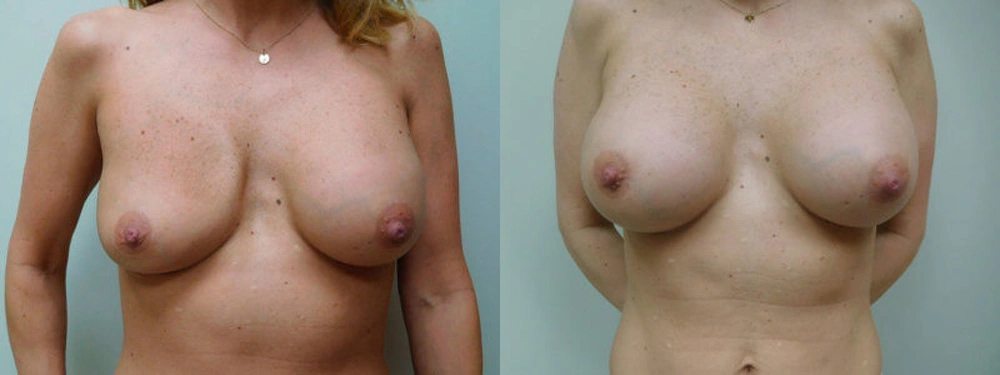 Real patient results in Owings Mills, MD Performed by Steven J. Rottman MD