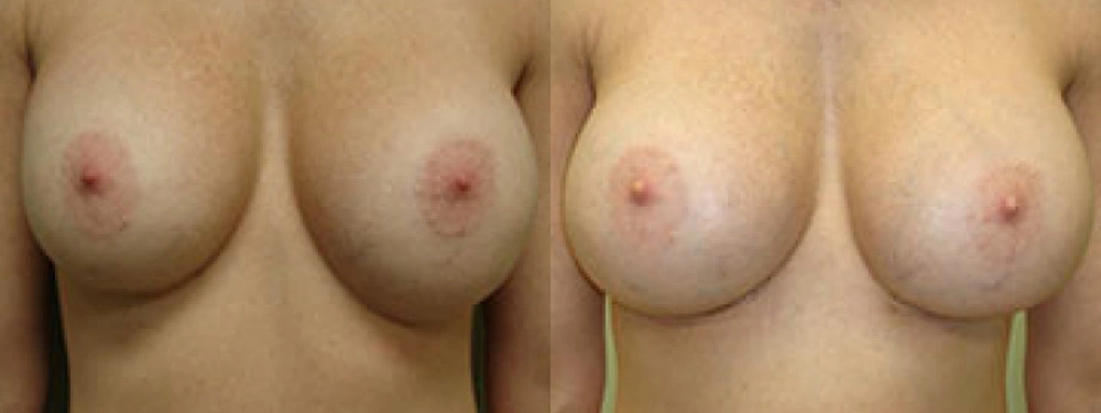 Real patient results in Owings Mills, MD Performed by Steven J. Rottman MD