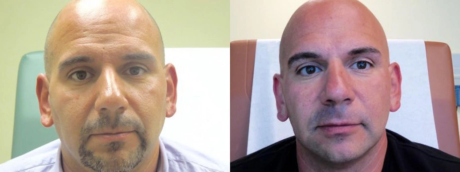 Real patient results in Owings Mills, MD Performed by Steven J. Rottman MD