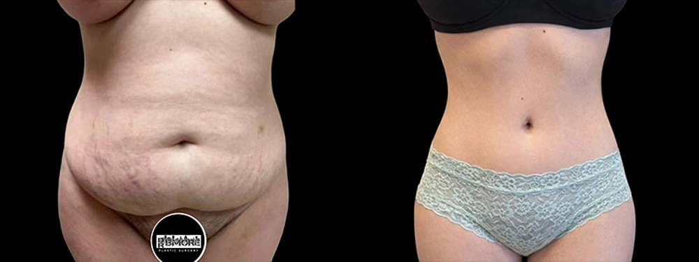 Real patient results in Owings Mills, MD Performed by Steven J. Rottman MD