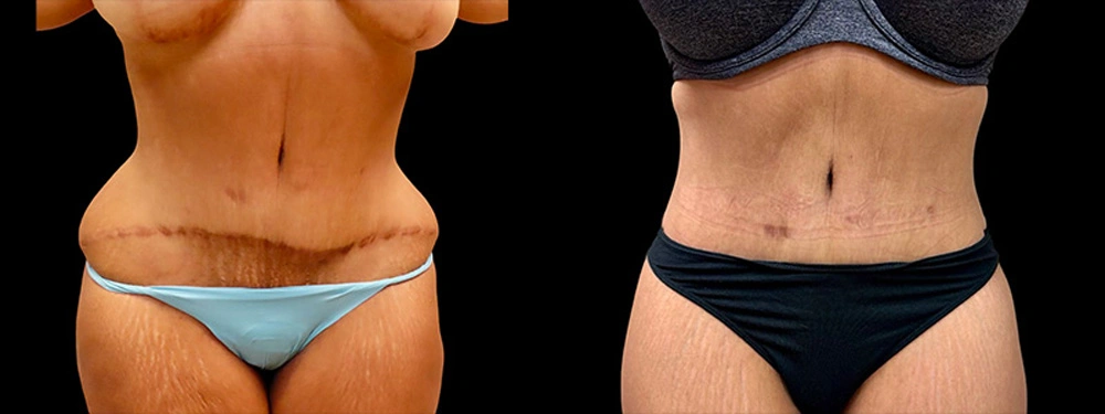 Real patient results in Owings Mills, MD Performed by Steven J. Rottman MD