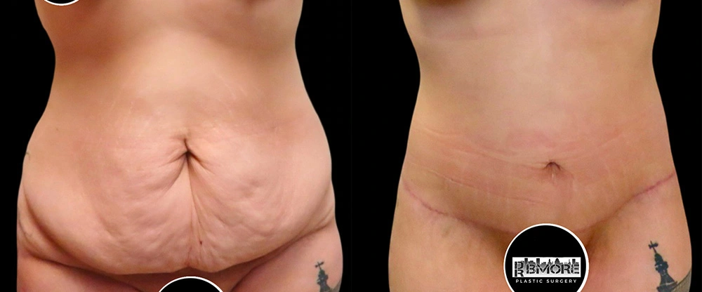 Real patient results in Owings Mills, MD Performed by Steven J. Rottman MD