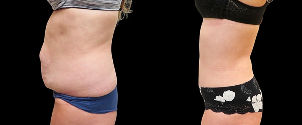 Real patient results in Owings Mills, MD Performed by Steven J. Rottman MD