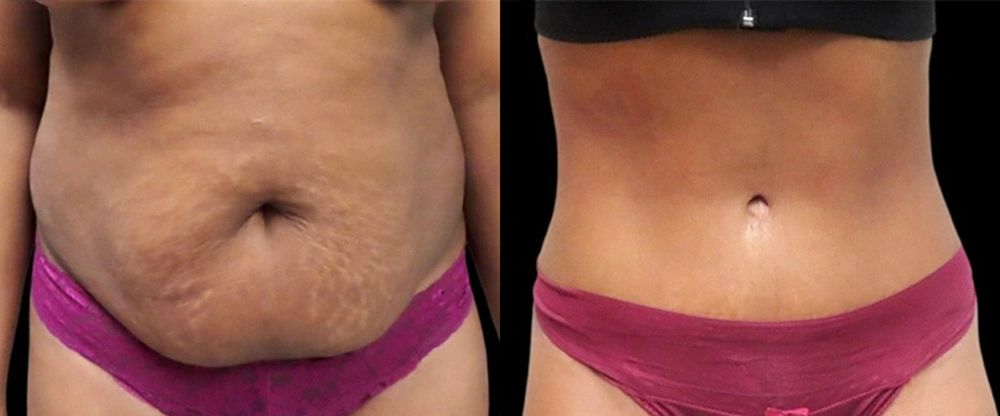 Real patient results in Owings Mills, MD Performed by Steven J. Rottman MD
