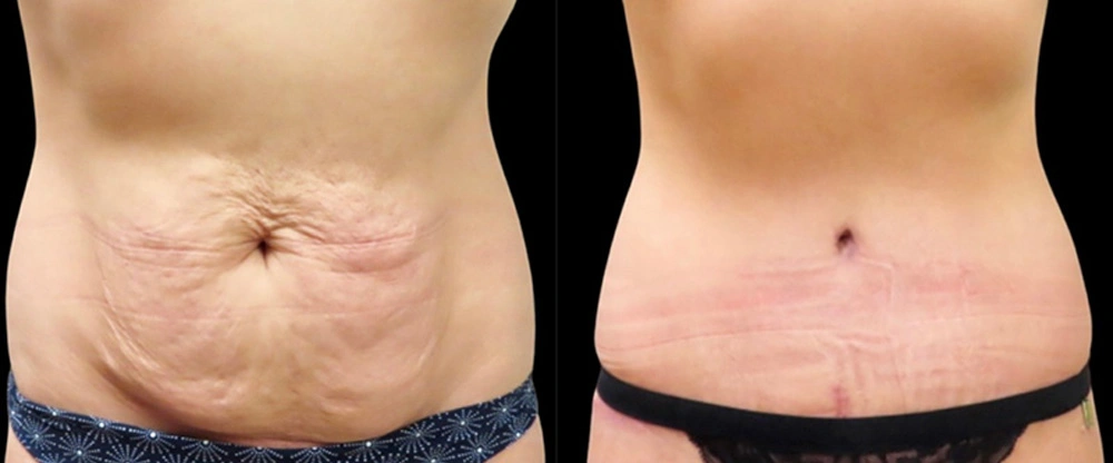 Real patient results in Owings Mills, MD Performed by Steven J. Rottman MD