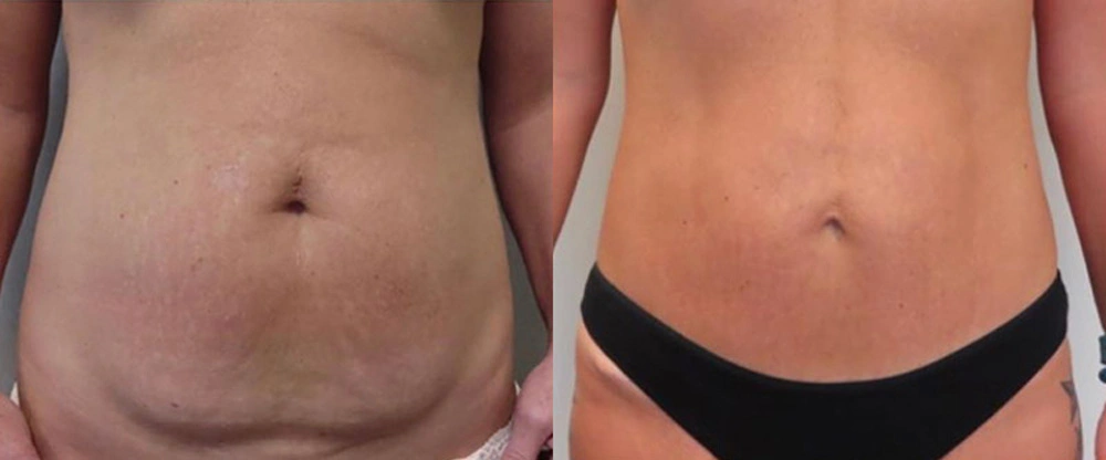 Real patient results in Owings Mills, MD Performed by Steven J. Rottman MD