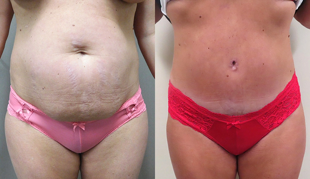 Real patient results in Owings Mills, MD Performed by Steven J. Rottman MD
