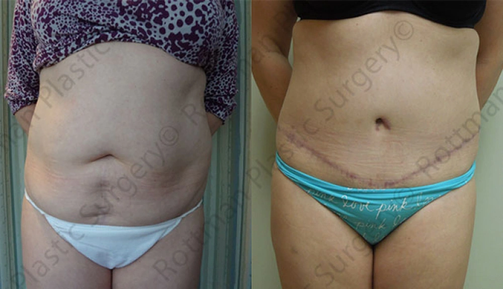 Real patient results in Owings Mills, MD Performed by Steven J. Rottman MD