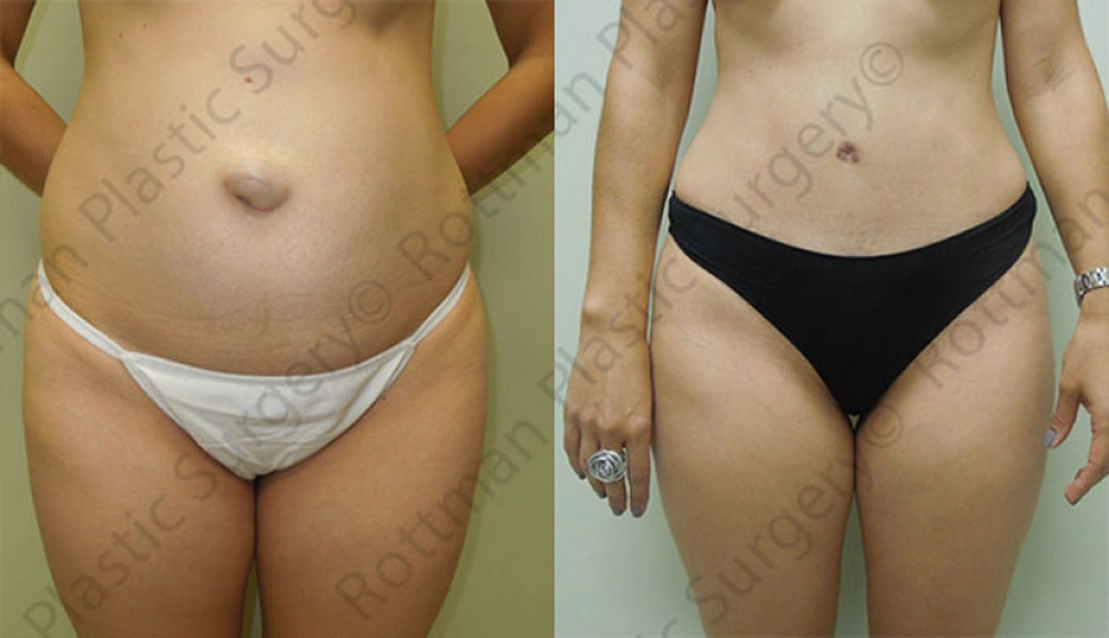 Real patient results in Owings Mills, MD Performed by Steven J. Rottman MD