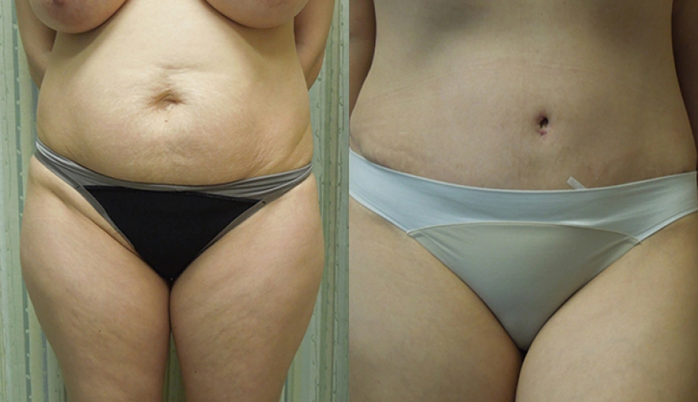Real patient results in Owings Mills, MD Performed by Steven J. Rottman MD