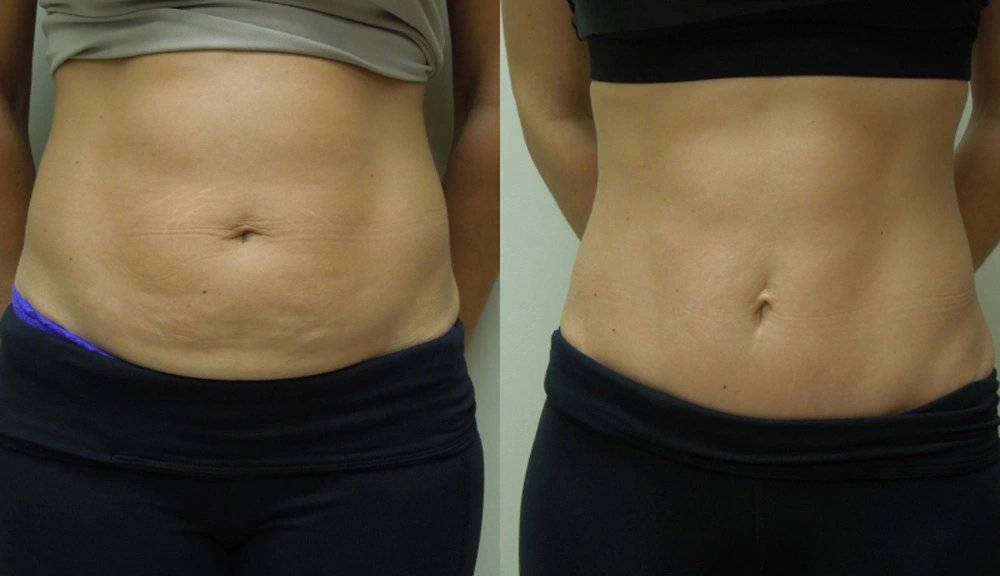 Real patient results in Owings Mills, MD Performed by Steven J. Rottman MD
