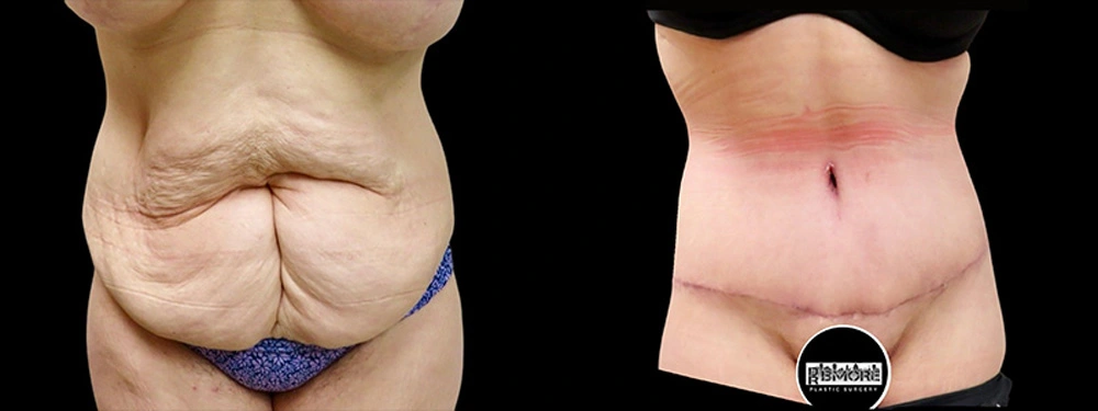 Real patient results in Owings Mills, MD Performed by Steven J. Rottman MD