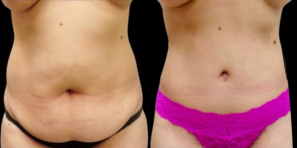 Real patient results in Owings Mills, MD Performed by Steven J. Rottman MD