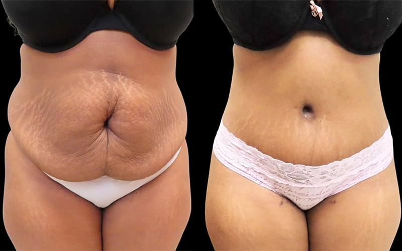 Real patient results in Owings Mills, MD Performed by Steven J. Rottman MD